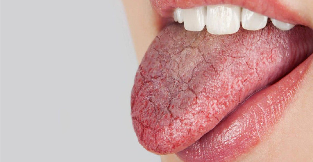 Xérostomie : Comment soulager la bouche sèche? – Boutique X-PUR